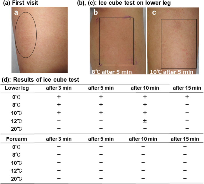 Frontiers Publishing Partnerships | Localized cold urticaria with ...