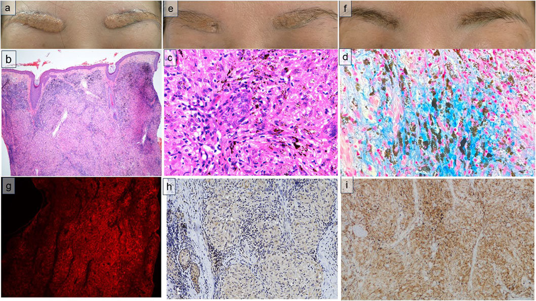 Frontiers Publishing Partnerships | A case of sarcoidal foreign body ...