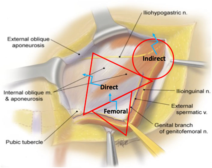 Frontiers Publishing Partnerships  The Role of Releasing Incisions in  Emergency Inguinal Hernia Repair