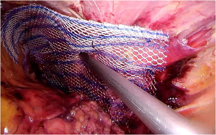 Hernia Repair Using Mesh, General Surgery Clinic Articles