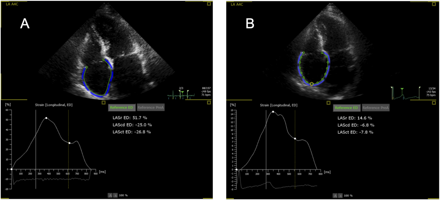 Ultrasound images labeled A and B, showing myocardial strain analysis. Both images display echocardiographic views with highlighted sections in blue and green. Graphs below depict strain measurements over time. Panel A shows higher values: LASr 51.7%, LAScd -25.0%, LASct -26.8%. Panel B shows lower values: LASr 14.6%, LAScd -6.8%, LASct -7.8%.