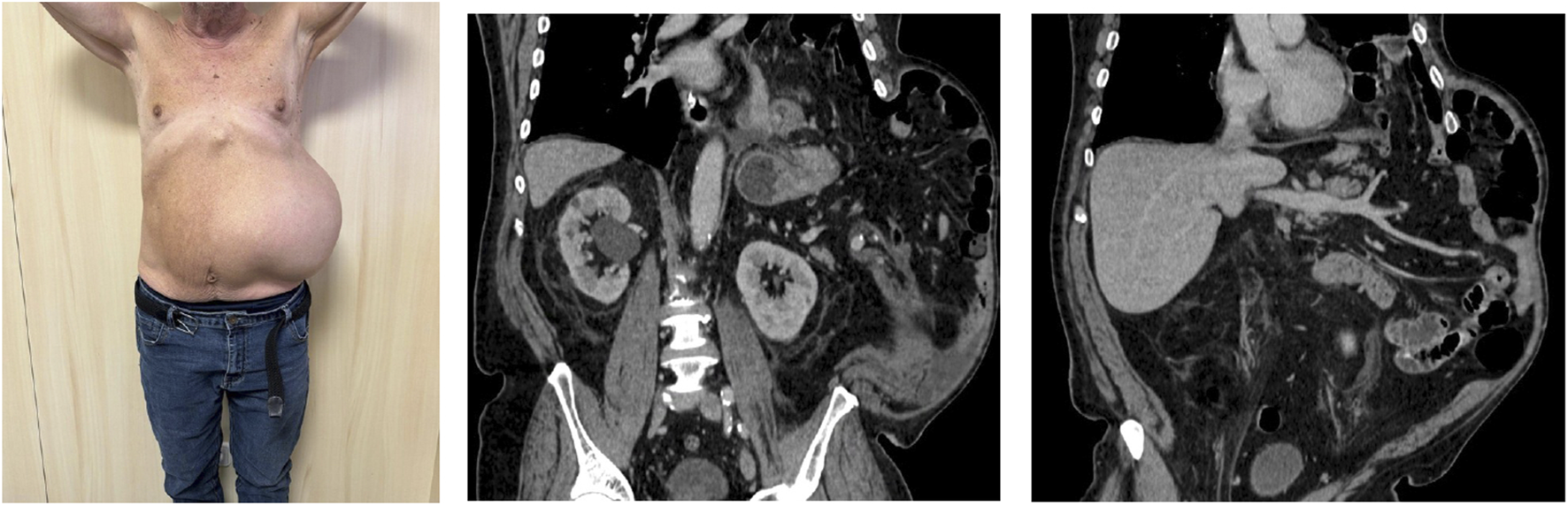 A composite image featuring a person with a protruding abdomen standing against a wooden background with arms raised, and two adjoining abdominal CT scan images revealing internal structures and organs from different angles.