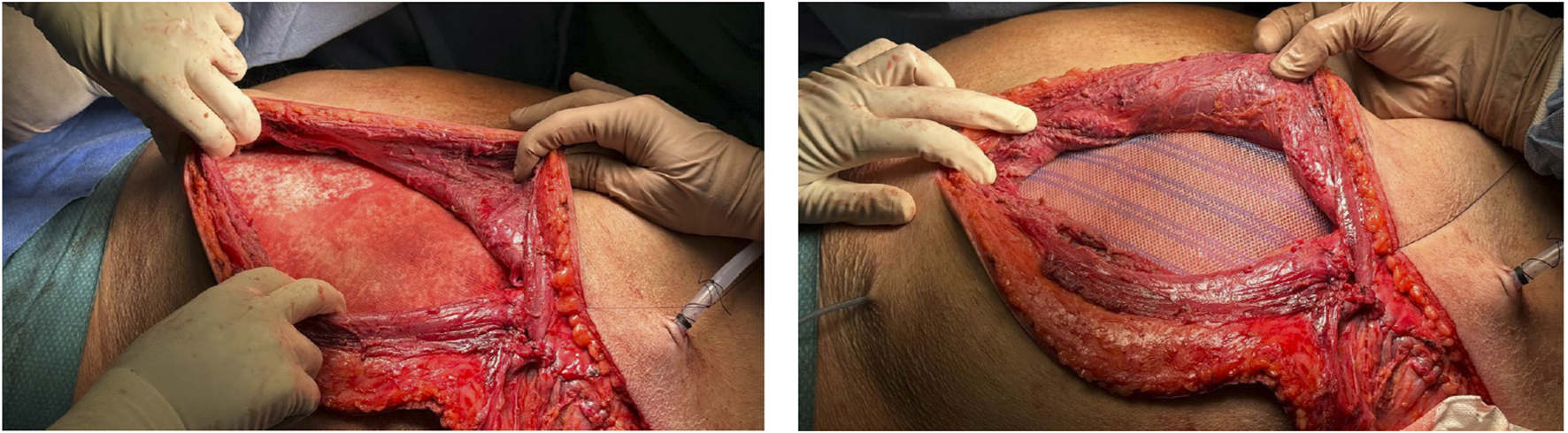 Two-panel image showing a surgical procedure on the abdomen. The left panel depicts exposed abdominal tissue with hands holding back the skin. The right panel shows a surgical mesh placed over the exposed area, with gloved hands adjusting it.