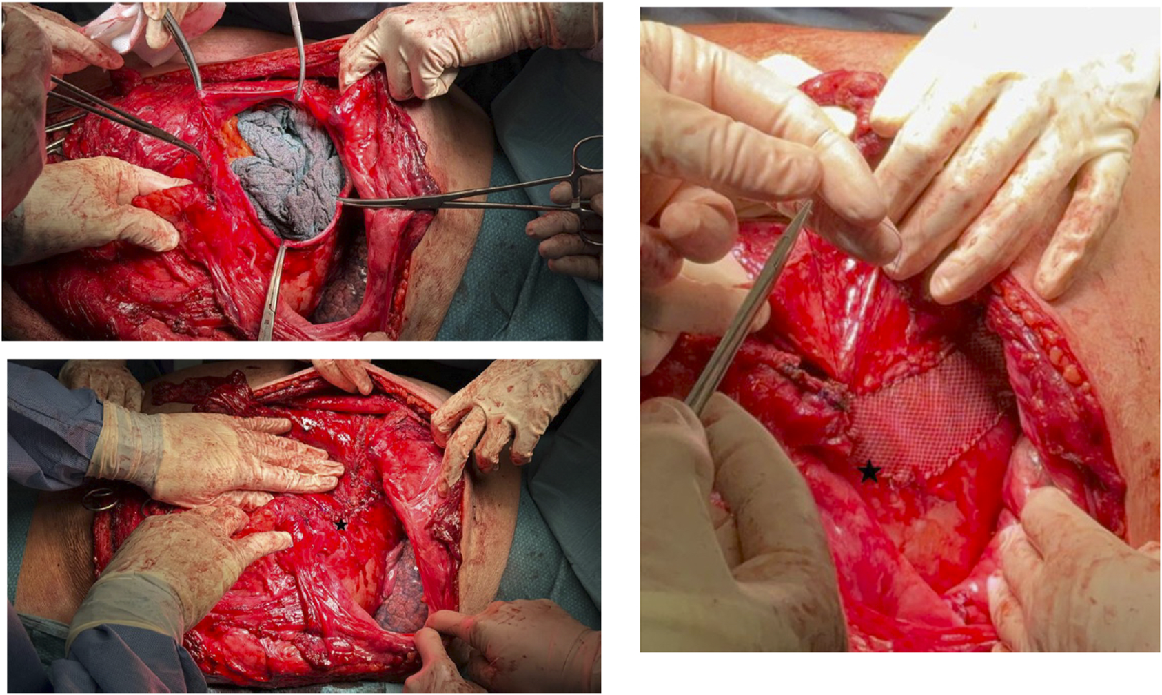 Series of images depicting a surgical procedure with gloved hands using instruments. One image shows a mesh being placed, while others reveal detailed tissue manipulation and interaction with exposed organs.