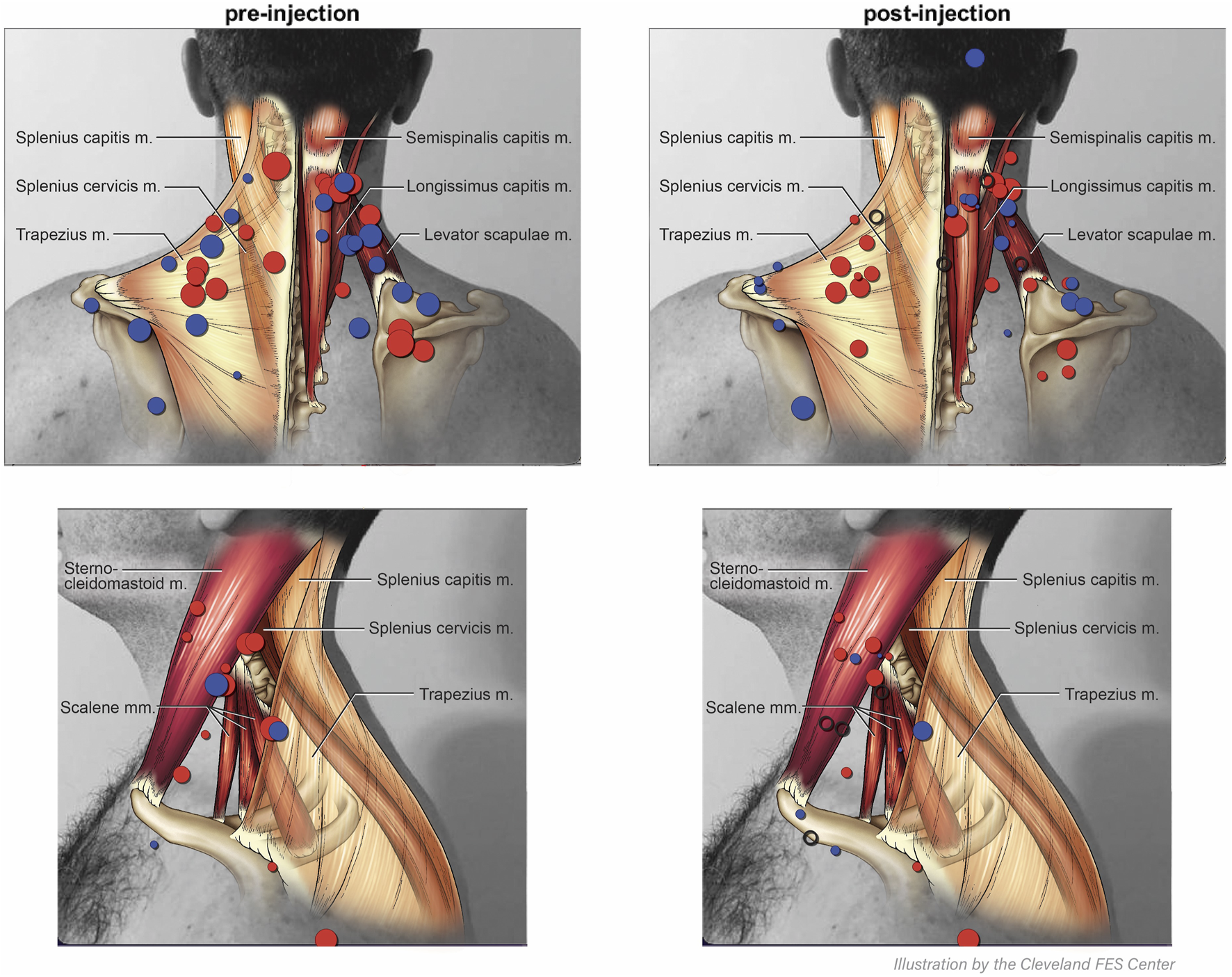 Illustration showing back and side views of neck and shoulder muscles labeled pre-injection and post-injection. The pre-injection images have red and blue markers indicating various points on the muscles, including splenius capitis, semispinalis capitis, splenius cervicis, trapezius, longissimus capitis, and levator scapulae. Post-injection images show reduced markers. Lateral views include sternocleidomastoid and scalene muscles.