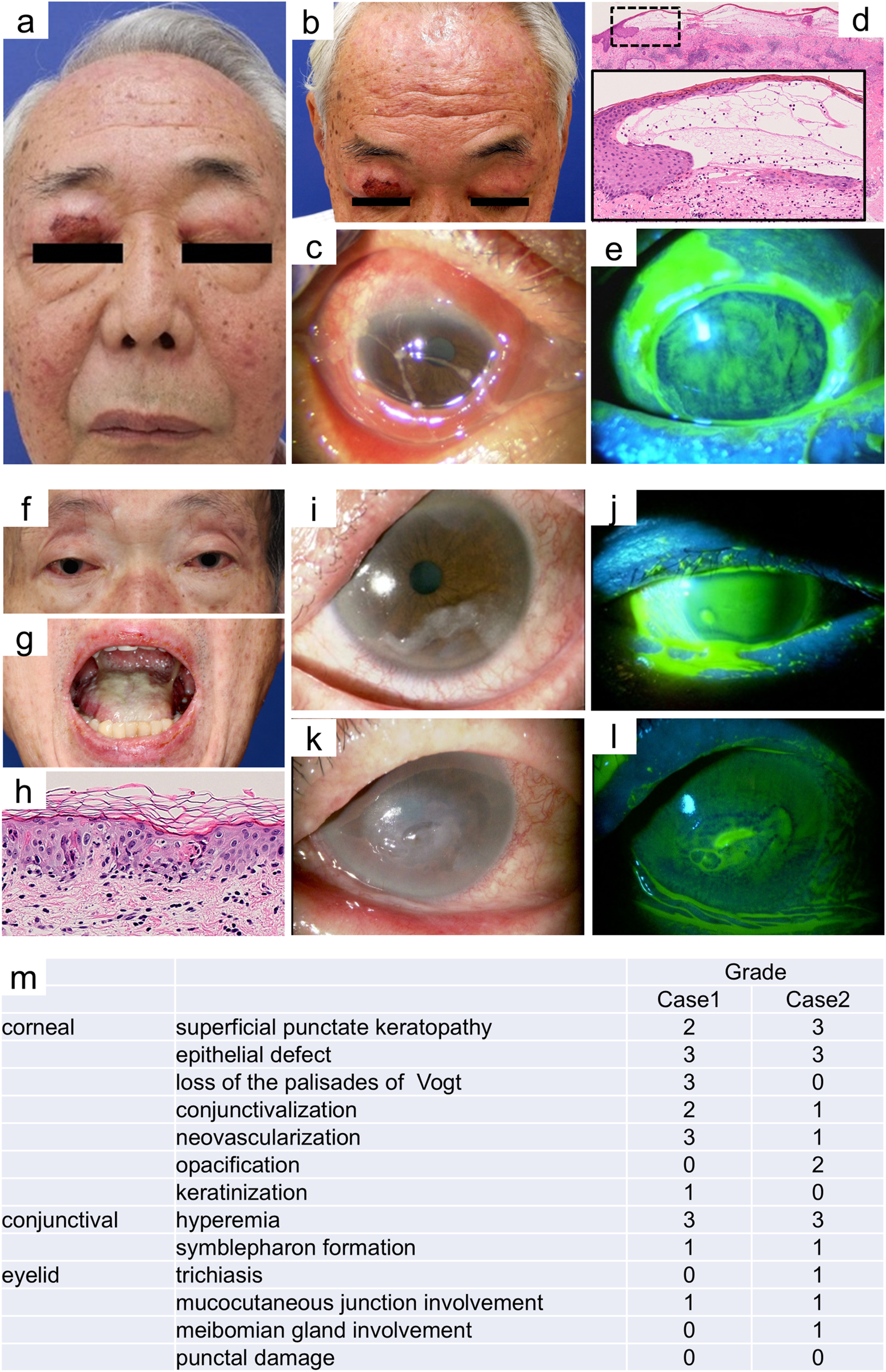 A series of medical images and a table labeled from a to m. Images a, b, f show partially obscured faces with various eye and skin conditions. Images c, e, i, j, k, l display close-ups of eyes with different abnormalities, under regular and fluorescent light. Images d, h show histological skin sections. Image m is a table grading ocular conditions for two cases, listing corneal, conjunctival, and eyelid issues, with grades from zero to three.