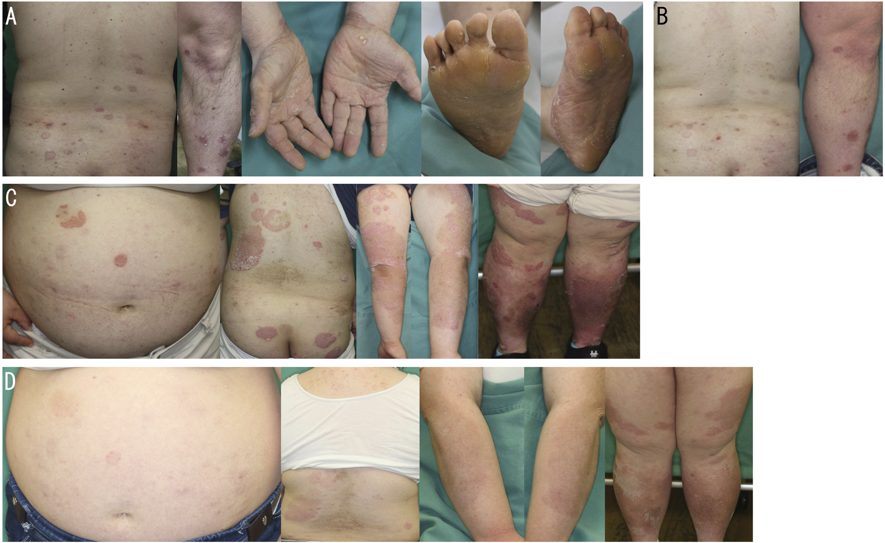 Individuals with visible dermatological conditions, such as psoriasis, on different body parts including the back, arms, hands, feet, legs, and abdomen. The images show varying degrees of redness, scaling, and inflammation associated with the skin condition. Each panel highlights specific areas affected, demonstrating similarities and differences in symptom presentation.