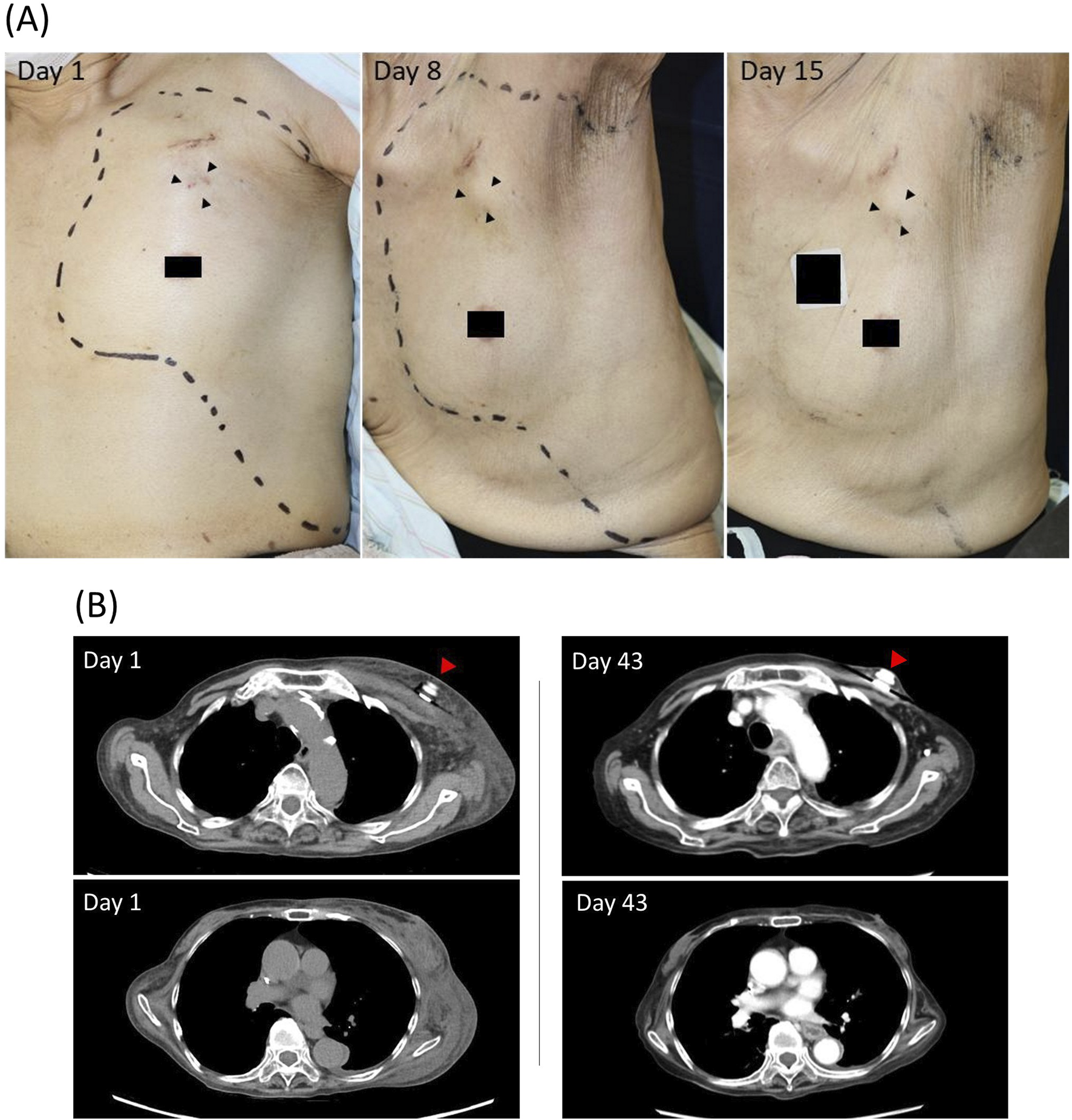 (A) Series of three clinical photographs over days one, eight, and fifteen showing a time-course in the oxaliplatin-extravasated area. Arrowheads, the site where a totally implantable venous access device is implanted. (B) CT scan images comparing chest areas on days one and forty-three. Arrowhead, the totally implantable venous access device.