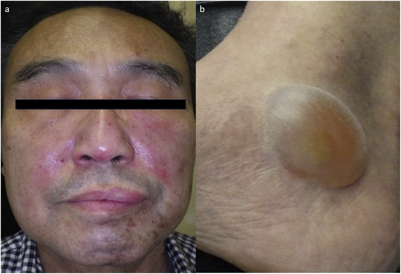 Panel a shows a person with facial redness and swelling, particularly around the cheeks and nose. Panel b depicts a large, fluid-filled blister on the skin.