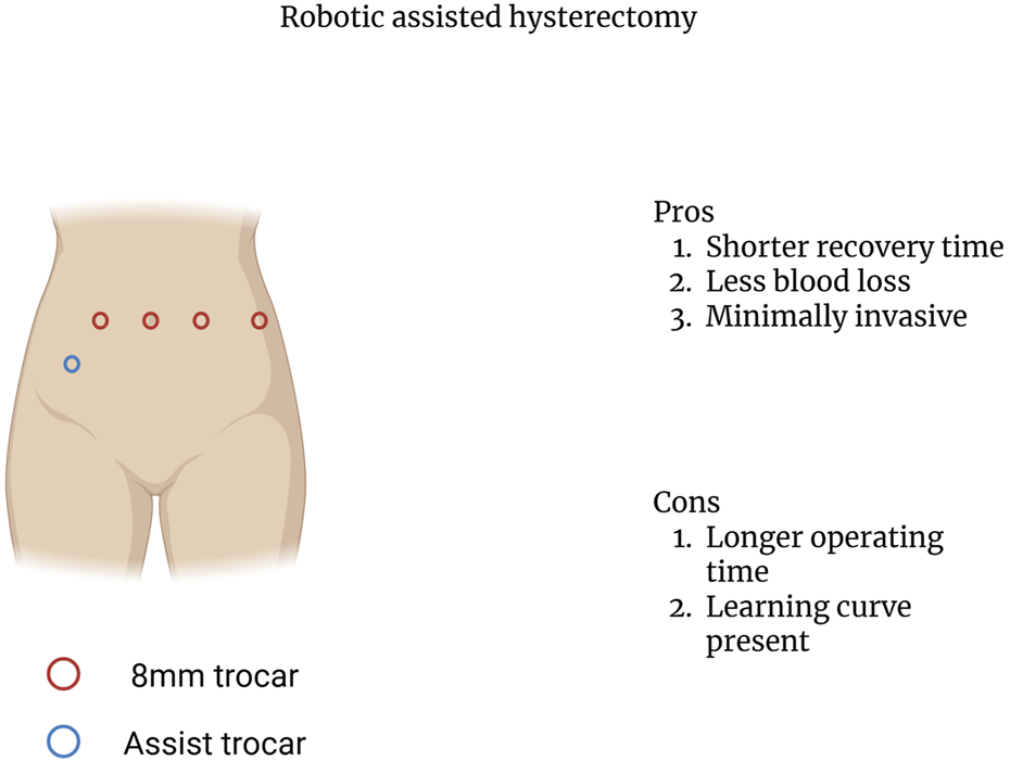 Diagram illustrating trocar placement for a robotic-assisted hysterectomy on an abdomen. Four red circles represent eight-millimeter trocars, and one blue circle represents an assist trocar. Pros listed: shorter recovery time, less blood loss, and minimally invasive. Cons listed: longer operating time and learning curve required.