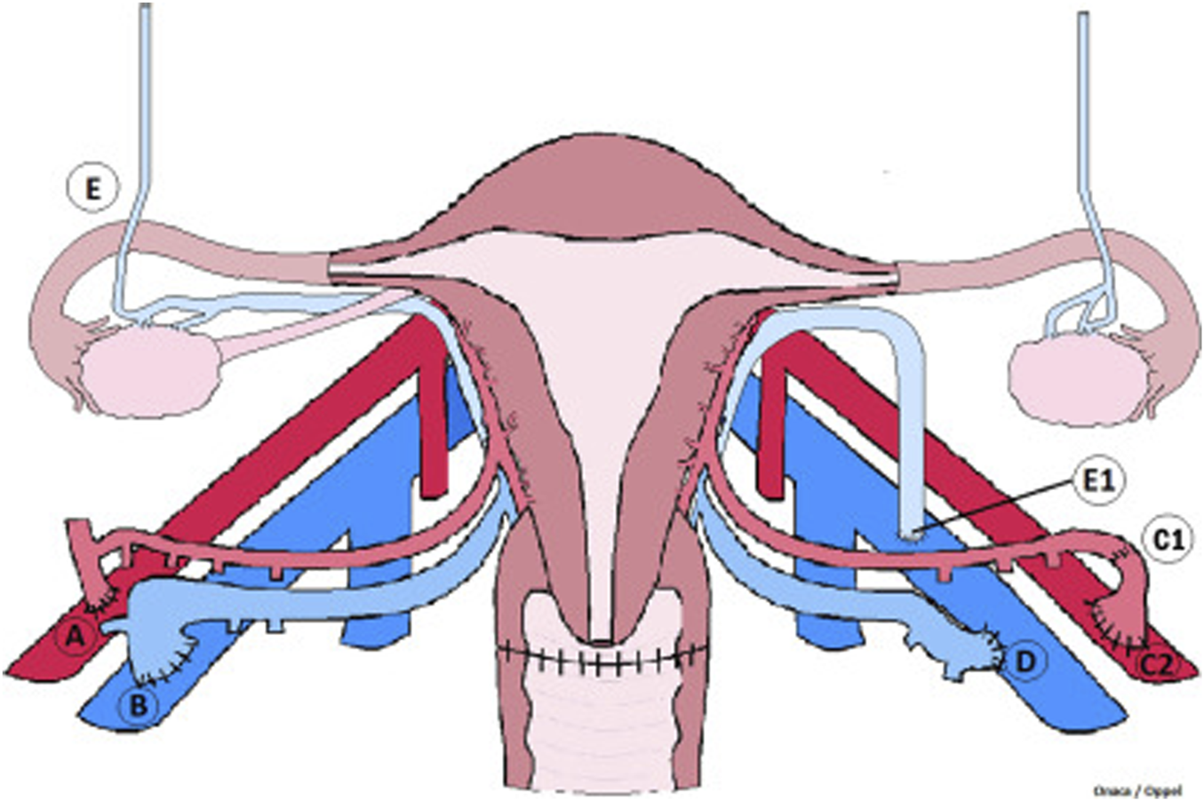Diagram showing female reproductive anatomy with colored paths illustrating different surgical procedures. Labeled sections include uterus, fallopian tubes, and ovaries, with blue and red paths indicating routes for surgical access. Various parts are marked with letters A to E, indicating specific areas related to procedures.