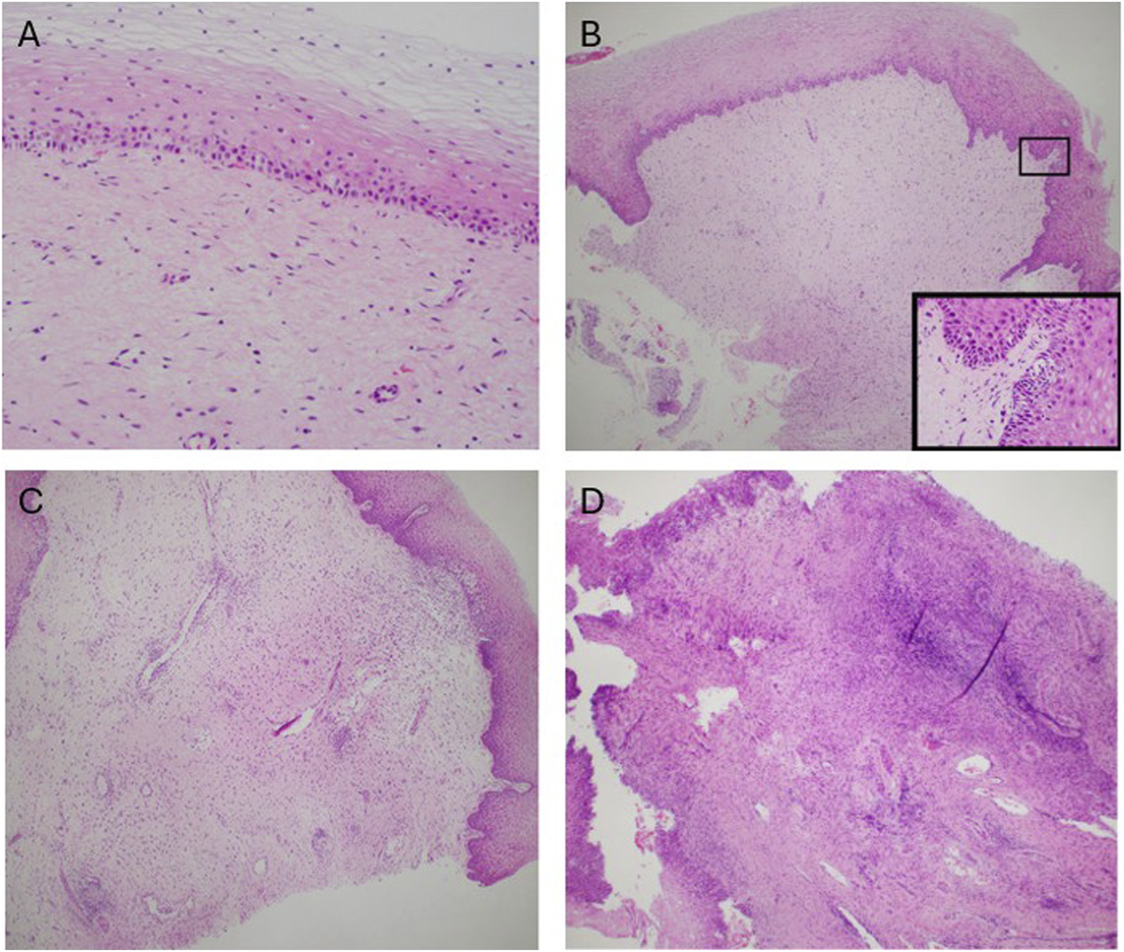 Histological images of tissue sections, labeled A through D. Panel A shows a close-up of a stratified epithelial layer. Panel B displays a tissue section with a highlighted inset, showing cellular details. Panel C reveals a uniform tissue area with sparse cellularity. Panel D presents a densely packed, irregular cellular pattern. Each panel likely illustrates different pathological or normal tissue states.