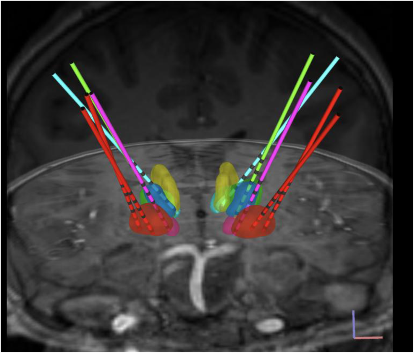 MRI scan of the brain shows colorful paths of electrode trajectories targeting specific brain regions. The annotated paths in various colors intersect areas marked in yellow and blue, indicating electrode placement for analysis or treatment.