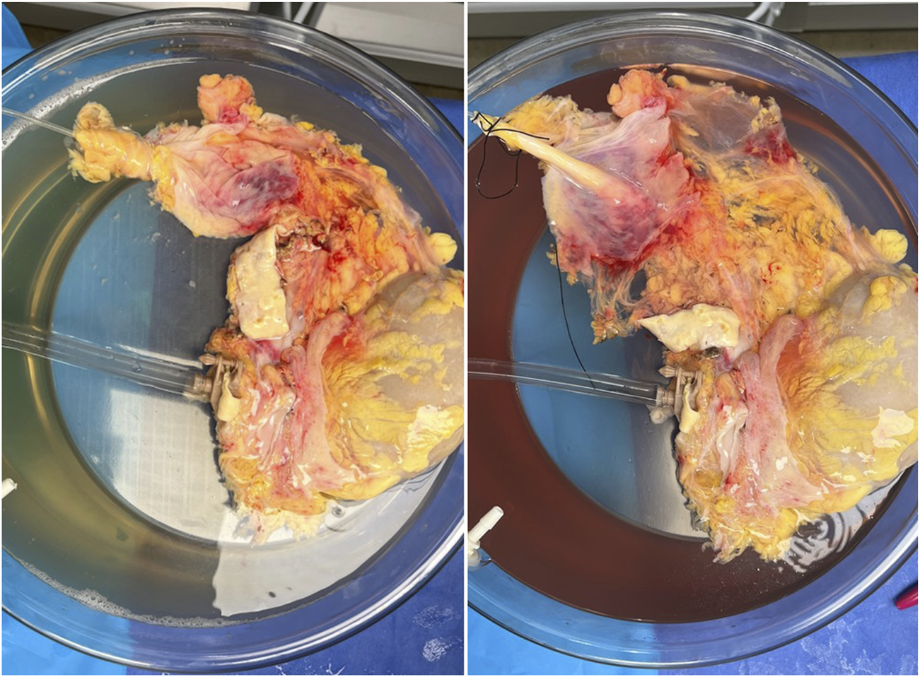 Two side-by-side images show the same human kidney. The left image displays the kidney at the beginning of SNAP in the clear perfusate, while the right image features it at 120 minutes of SNAP.