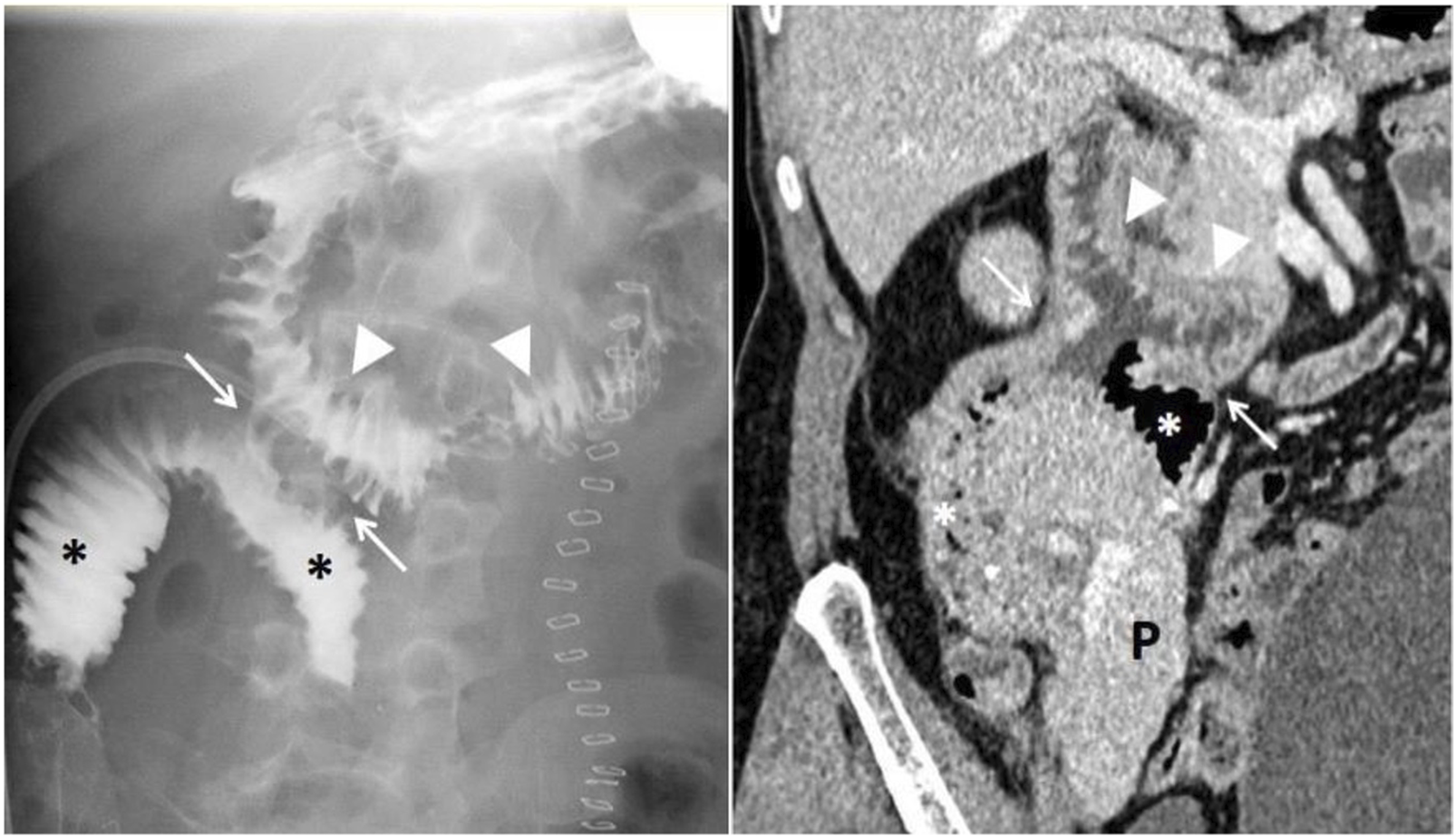 Two-panel medical imaging illustrating exocrine drainage following pancreas transplantation with duodenoduodenostomy. The right panel shows an abdominal X-ray depicting intestinal contours, with arrowheads marking appropriate contrast passage through the recipient’s duodenum, confirming anastomotic integrity and absence of leakage. The left panel presents an axial CT scan of the same patient, demonstrating the pancreatic graft in situ without evidence of postoperative complications after duodenoduodenostomy. Both images serve diagnostic purposes, highlighting normal postoperative findings and providing visual confirmation of successful exocrine drainage without adverse events.