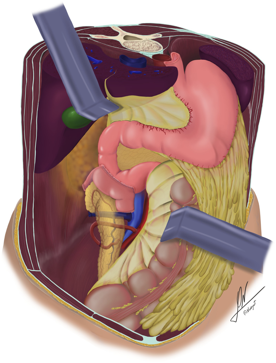 Medical illustration showing a transverse section of the human abdomen with retrocolic positioning of the pancreatic graft. The image demonstrates systemic venous outflow and enteric drainage achieved through a side-to-side duodeno-duodenal anastomosis. Visible organs include the stomach, intestine, and liver, along with surrounding anatomical structures. Surgical retractors hold the abdominal cavity open. The illustration emphasizes spatial relationships between the pancreatic graft and native anatomy, serving as an educational and diagnostic reference for surgical anatomy, graft placement, and procedural planning in pancreas transplantation.