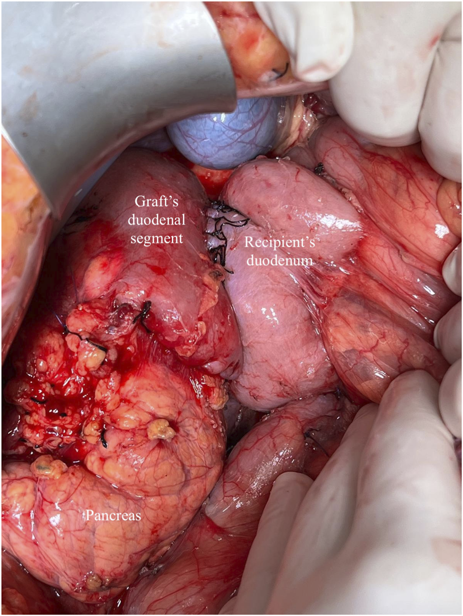 Intraoperative surgical image showing the duodenum and pancreas during a pancreas transplant procedure. The graft’s duodenal segment, the recipient’s duodenum, and the pancreas are clearly identified with labels. Gloved surgical hands are holding the organs in position to facilitate visualization. The image illustrates the anatomical orientation and spatial relationship between the graft and recipient structures, serving as a reference for surgical technique and procedural planning in pancreas transplantation.