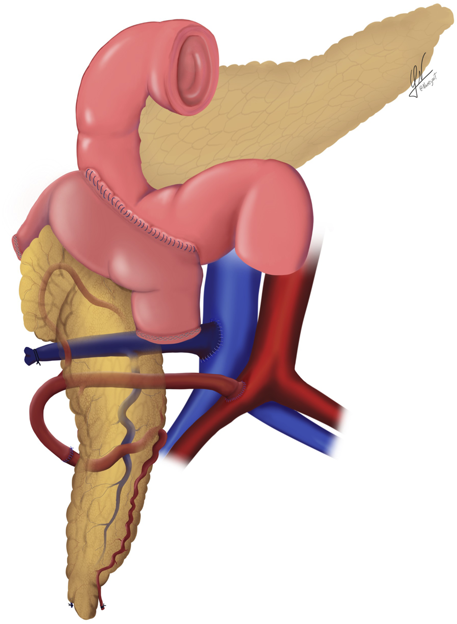 Medical illustration depicting the pancreas and surrounding vascular structures, highlighting a surgical reconstruction. The pancreas is shown in light brown, with red and blue vessels representing arterial and venous blood flow. Sections of the digestive tract are illustrated in pink, indicating anastomotic connections for exocrine drainage. The image emphasizes the configuration of systemic venous outflow and enteric drainage pathways.