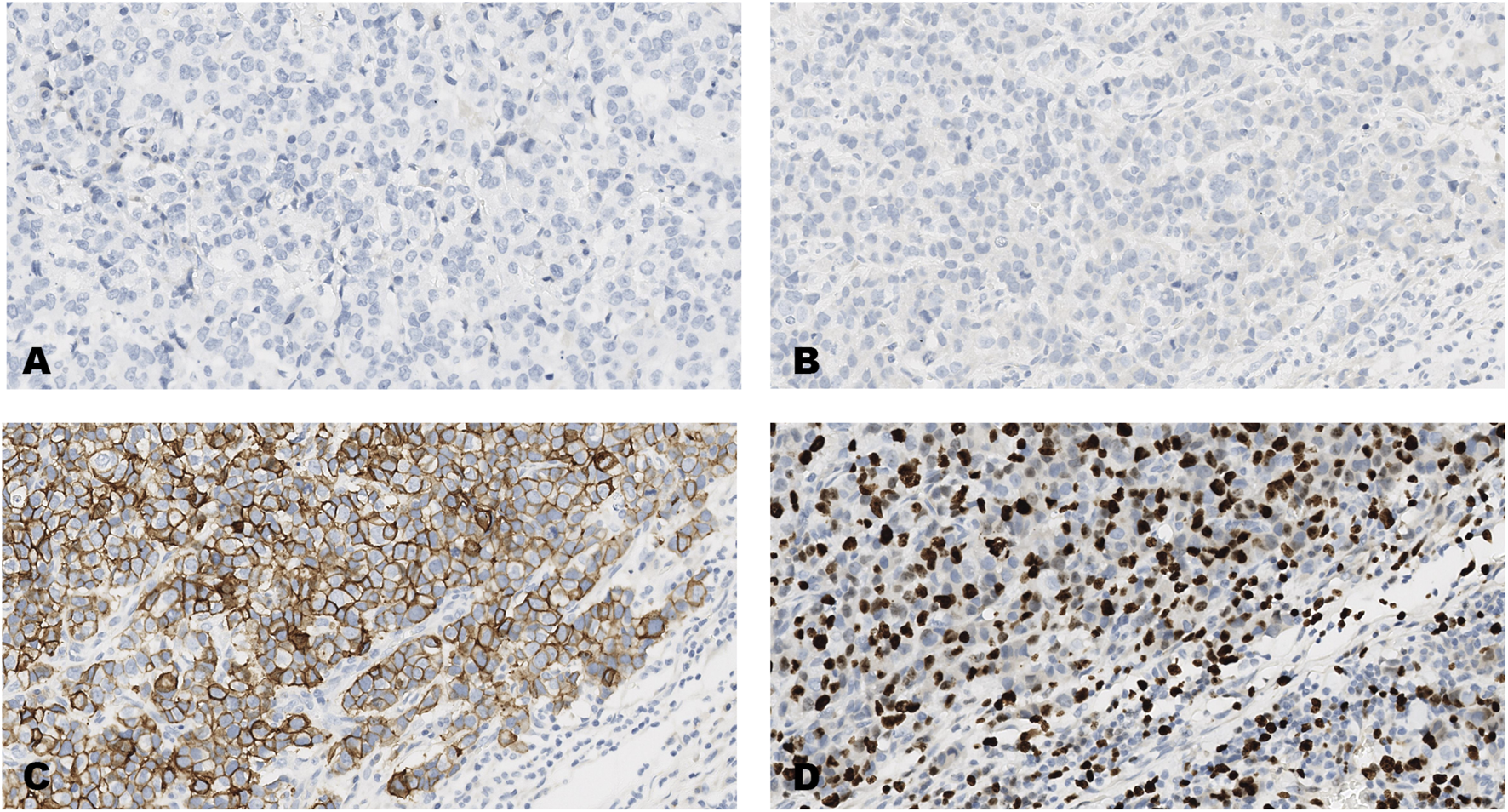 Four-panel image showing histological sections stained differently. Panel A: Light blue staining with scattered dark nuclei. Panel B: Similar to A with slightly denser pattern. Panel C: Cells stained with brown outlining cell membranes. Panel D: Numerous dark brown nuclei indicating intense staining.