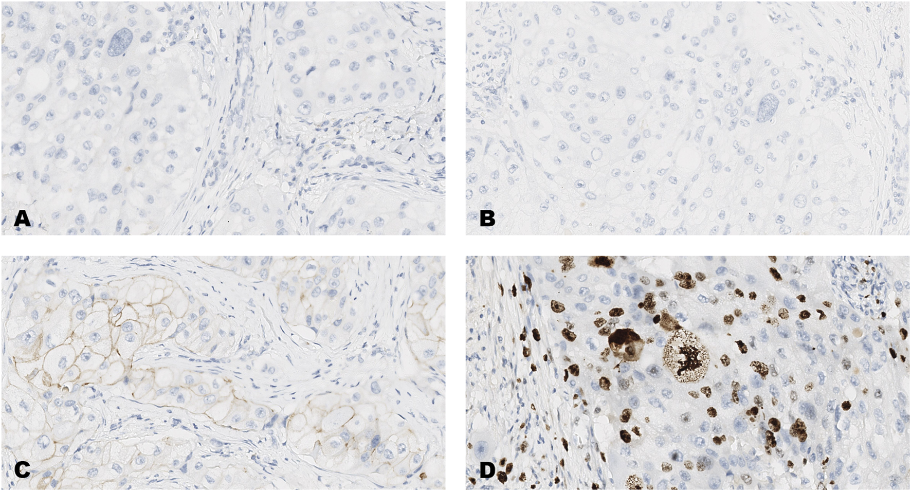 Four microscopic images labeled A, B, C, and D display tissue samples with varying levels of staining. A, B, and C show light staining with scattered blue-stained nuclei. D exhibits darker brown staining in numerous cells, indicating higher activity or protein presence.