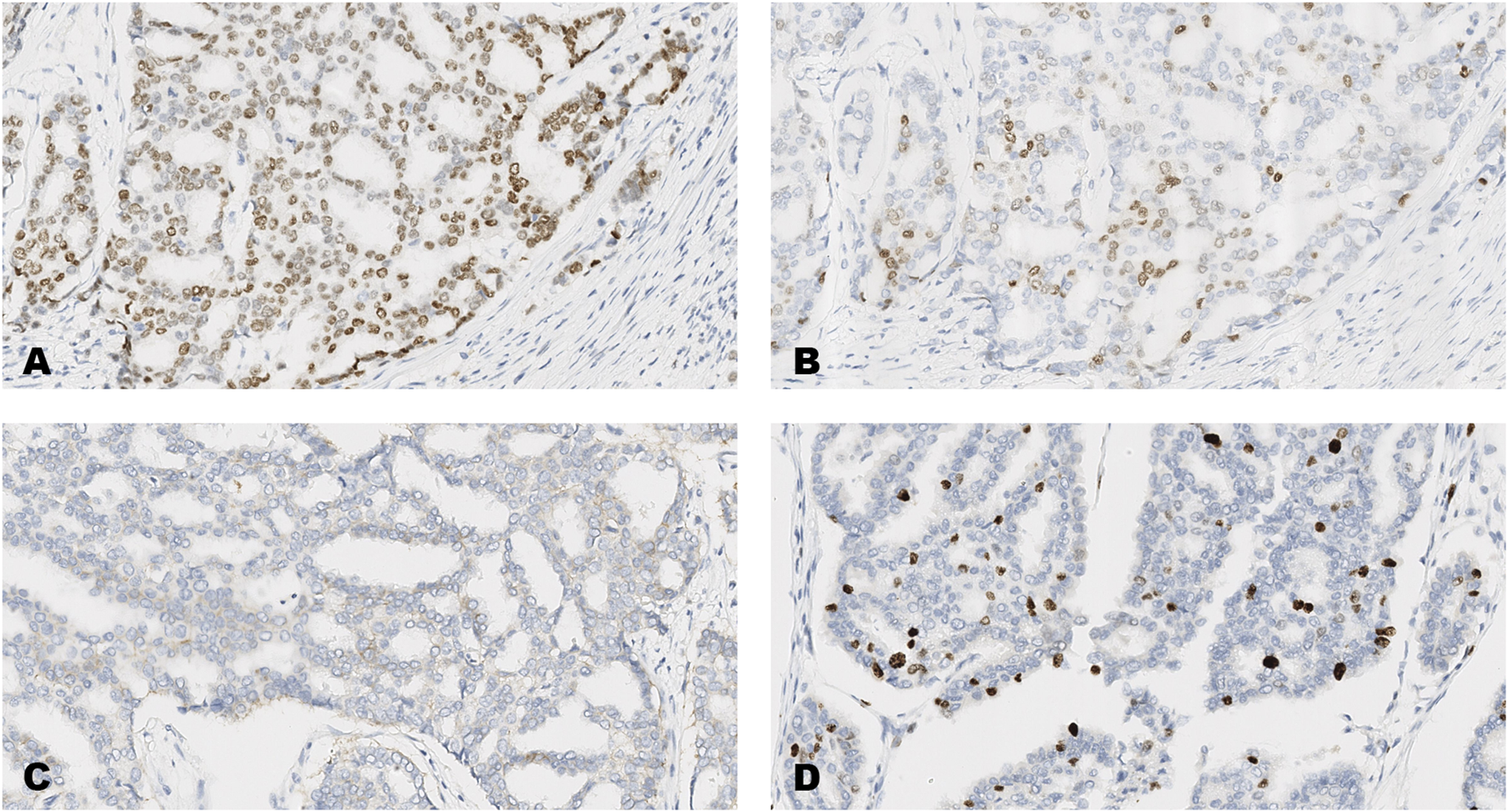 Four panels labeled A, B, C, and D show microscopic tissue sections. Panel A has densely stained brown nuclei, indicating higher expression levels. Panel B shows fewer stained nuclei. Panel C has the least staining, with mostly blue nuclei. Panel D exhibits moderate staining. These differences reflect varying levels of a specific marker in tissue samples.