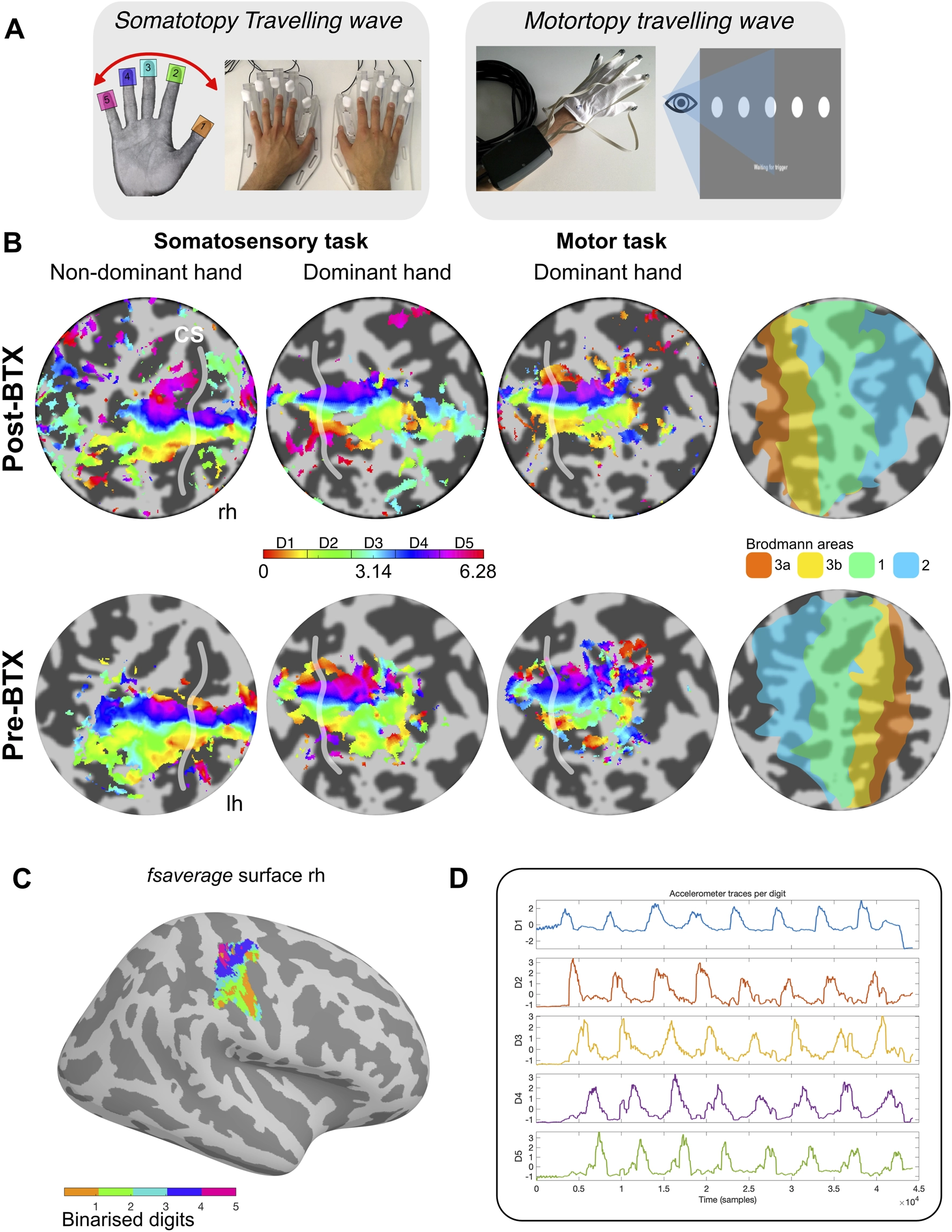 Panel A contains labeled diagrams for somatotopy and motor mapping tasks, including a hand with colored digit labels, hands on a device, a gloved hand, and a visual target scheme; panel B shows colored fMRI brain activation maps for somatosensory and motor tasks in pre- and post-botulinum toxin conditions, including Brodmann area overlays; panel C displays a 3D brain surface with digit-specific activation in color; panel D shows five line graphs of accelerometer traces for each digit, color-coded to match other panels.