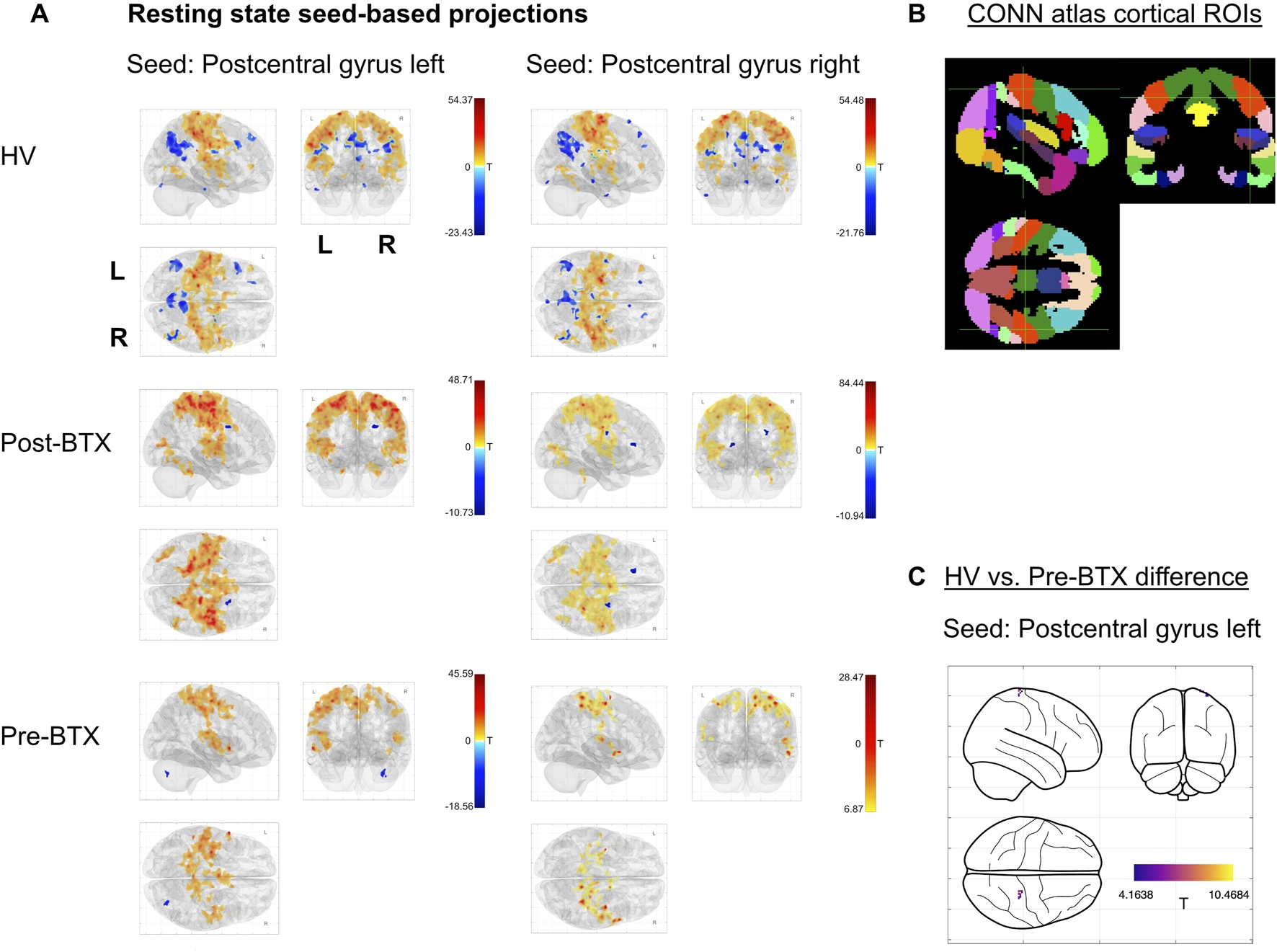 Panel A shows brain seed-based projection maps with color-coded statistical overlays for healthy volunteers (HV), post-botulinum toxin (Post-BTX), and pre-botulinum toxin (Pre-BTX) groups using left and right postcentral gyrus seeds. Panel B displays a graphical atlas of cortical regions of interest with distinct colors on black brain templates. Panel C shows a line drawing of the brain with overlaid regions indicating differences between HV and Pre-BTX for the left postcentral gyrus seed, using a purple-to-yellow color scale for T values.