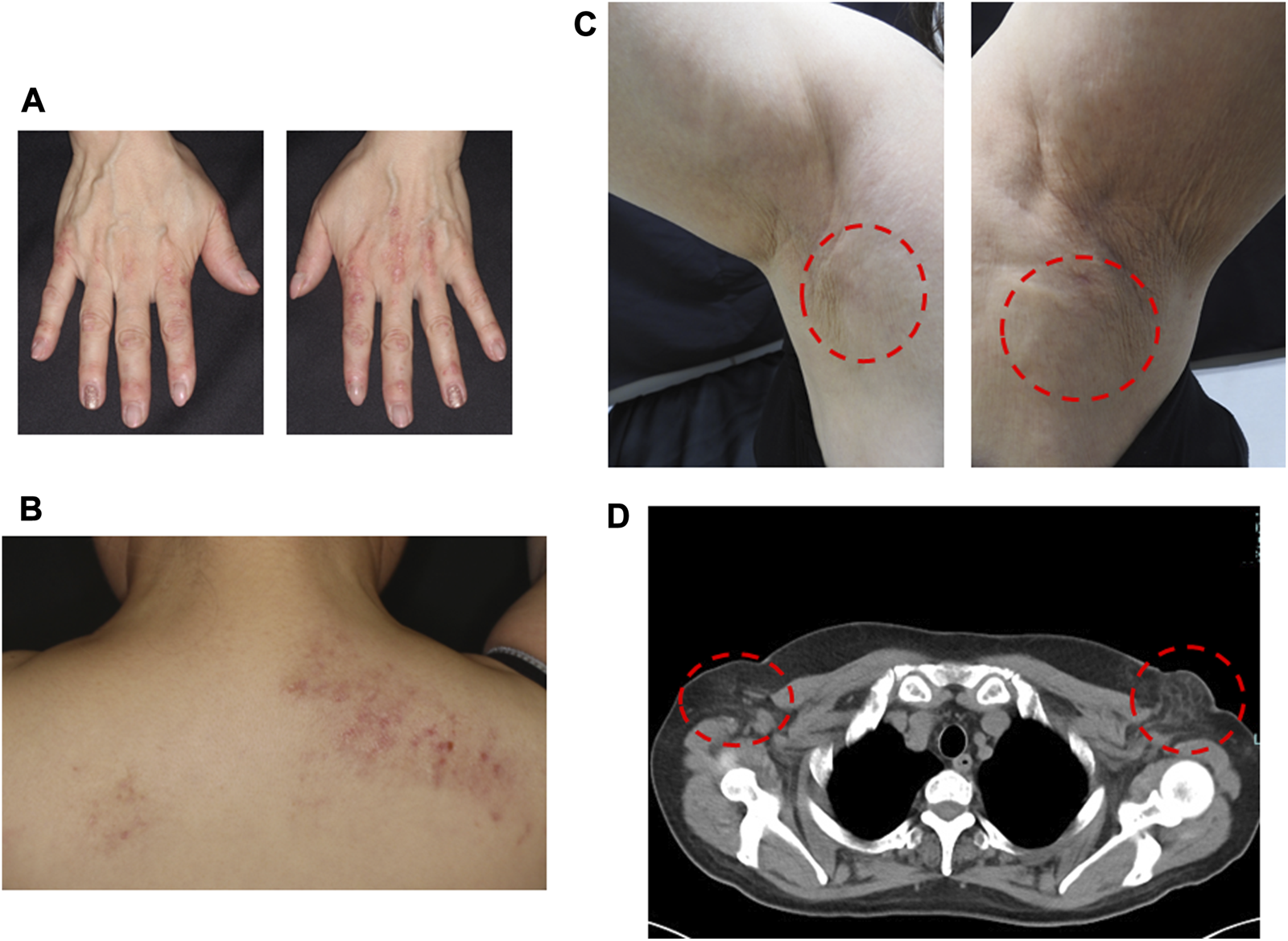 Panel A shows two hands with red, inflamed skin patches. Panel B displays a back with scattered red rashes on the shoulder area. Panel C illustrates armpits with highlighted areas in red circles, indicating affected skin. Panel D is a CT scan with red circles marking areas of interest near the shoulders.