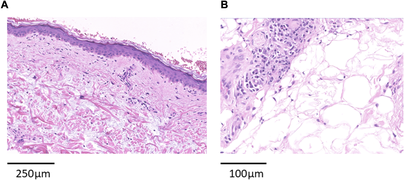 Two histological images labeled A and B. Image A shows a cross-section of skin layers with a clear epidermis and dermis, stained in pink and purple. Image B displays a section of tissue with dense cellular structures and surrounding larger, lighter areas, indicating fatty tissue. Scales indicate 250 micrometers for A and 100 micrometers for B.