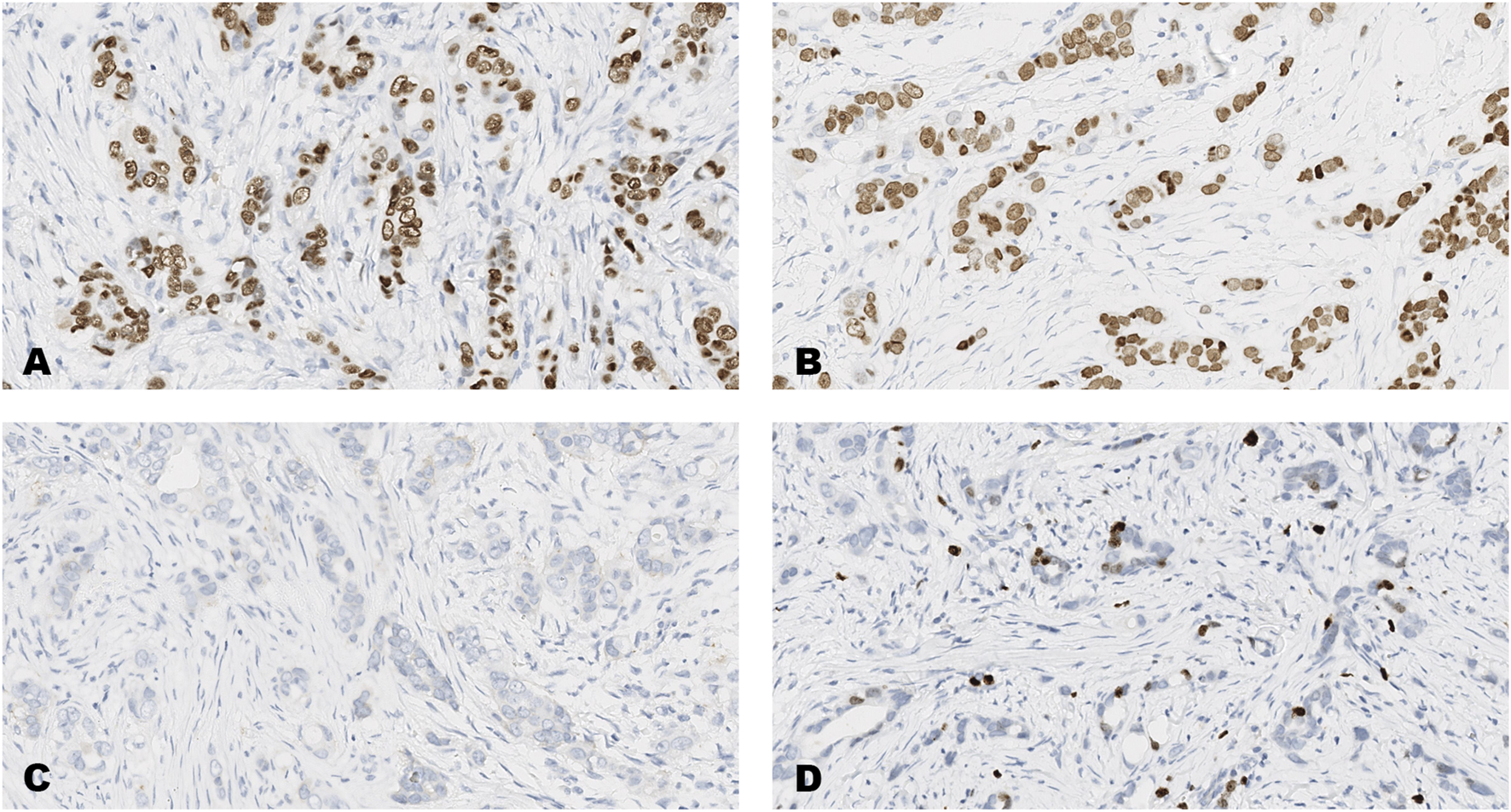 Histological images of invasive breast carcinomas that were tested by immunohistochemistry. The tumors show differing levels of protein expression for estrogen receptors (ER), progesterone receptors (PR), human epidermal growth factor receptor-2 (HER2) and Ki67.