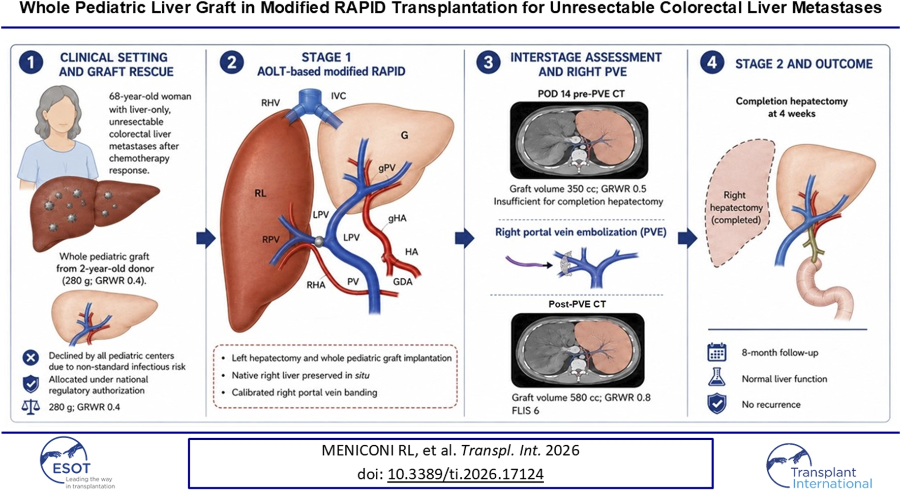Four-panel medical infographic illustrating whole pediatric liver graft in modified RAPID transplantation for unresectable colorectal liver metastases, showing patient case, surgical stages, pre- and post-procedure imaging, graft volume changes, and successful outcome with normal function at eight months.